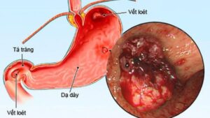 Nguyên nhân loét dạ dày: Vì sao niêm mạc dạ dày bị tổn thương và hình thành vết loét?