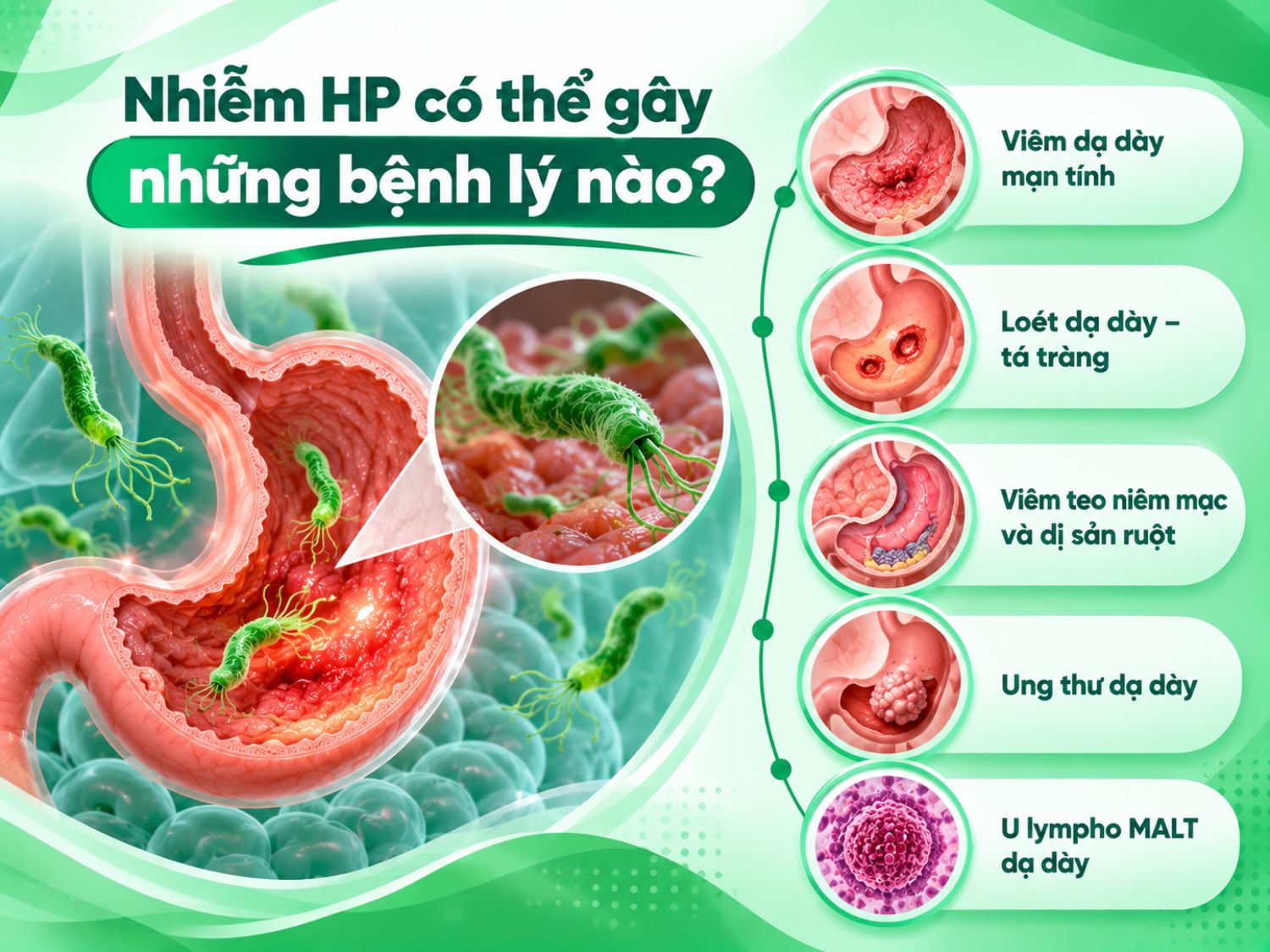 Nhiễm HP có thể liên quan đến nhiều bệnh lý dạ dày, từ viêm dạ dày mạn tính, loét dạ dày – tá tràng đến viêm teo niêm mạc, dị sản ruột, ung thư dạ dày và u lympho MALT.