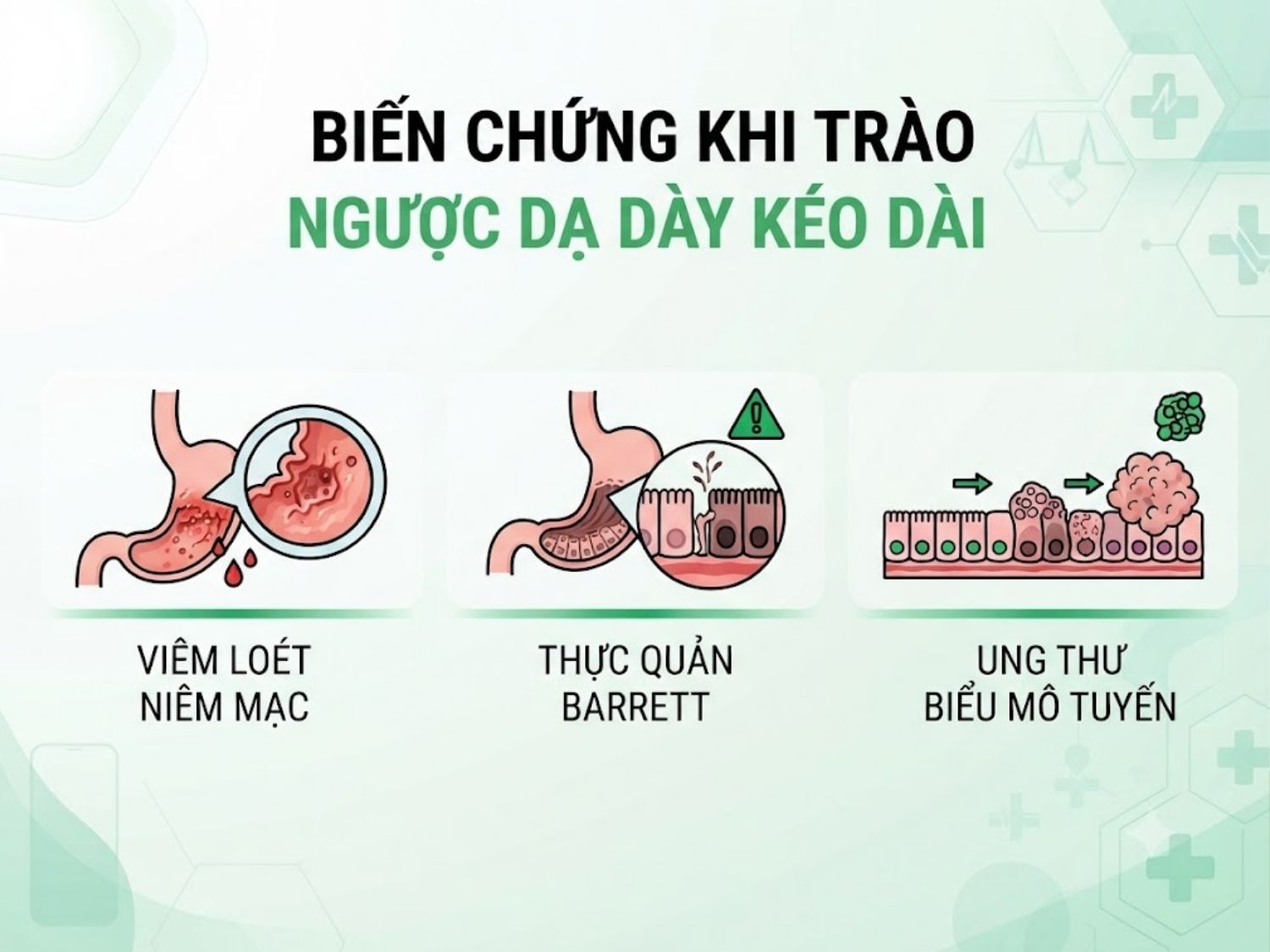 viêm loét niêm mạc, thực quản Barrett và ung thư biểu mô tuyến là biến chứng của trào ngược dạ dày