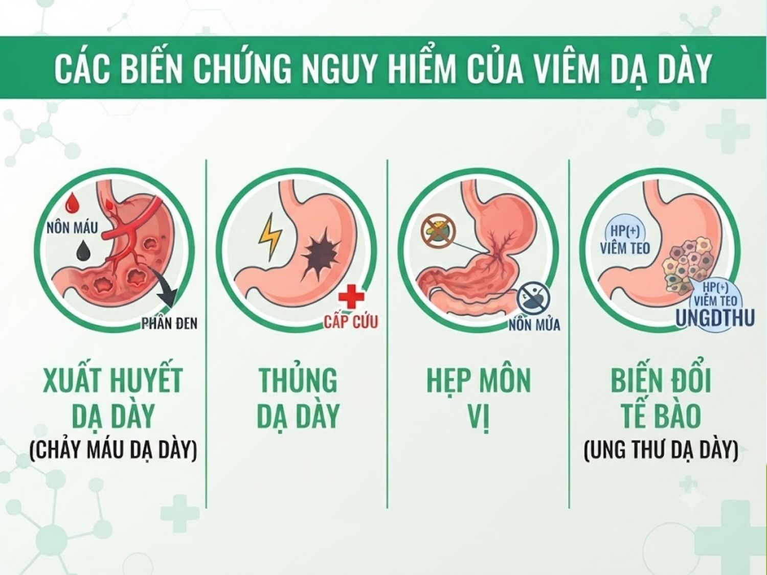 xuất huyết dạ dày, thủng dạ dày, hẹp môn vị và biến đổi tế bào dẫn đến ung thư dạ dày là biến chứng viêm dạ dày