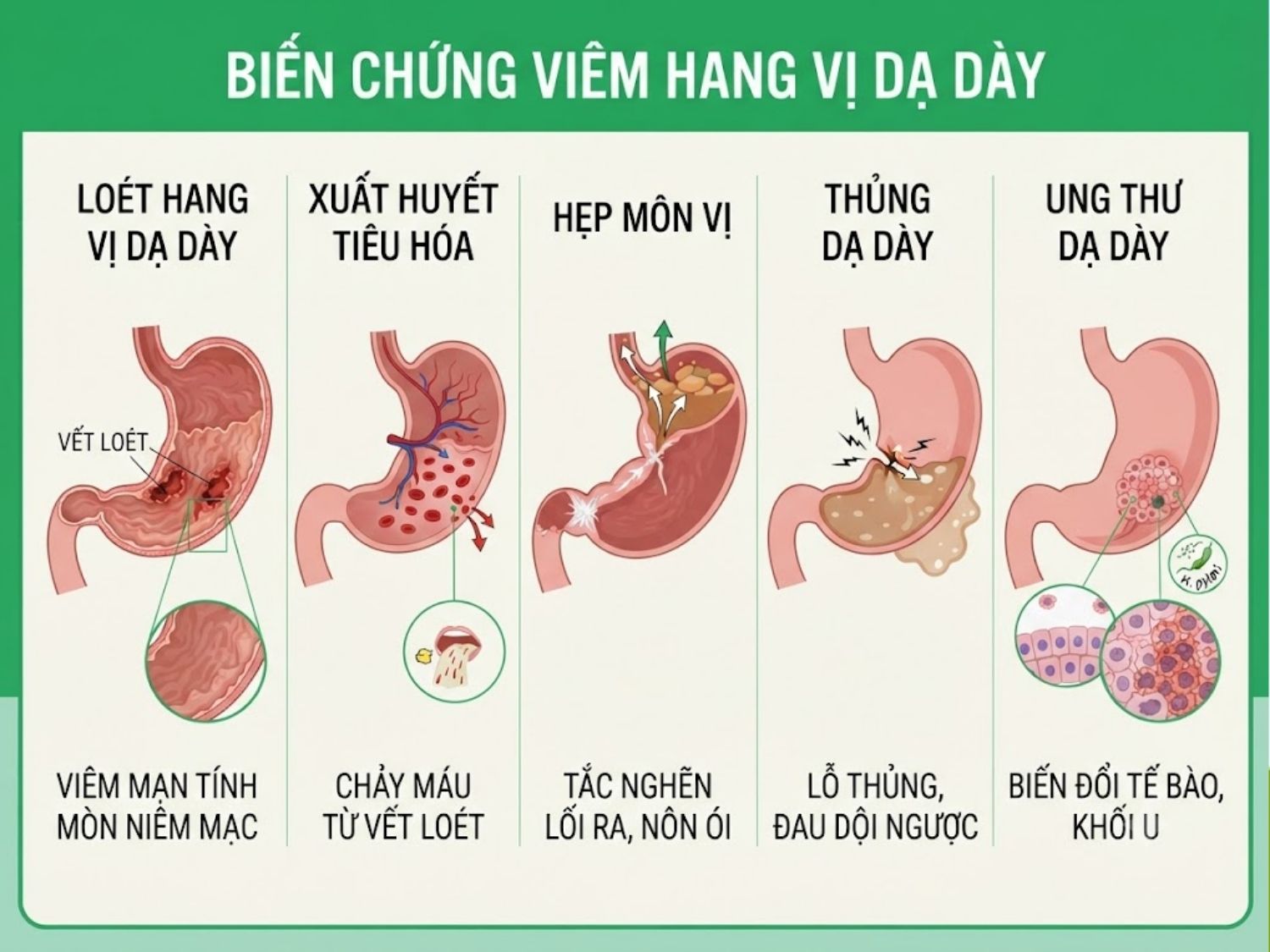 Viêm hang vị dạ dày nếu kéo dài có thể dẫn đến các biến chứng nguy hiểm như loét hang vị, xuất huyết tiêu hóa, hẹp môn vị, thủng dạ dày và tăng nguy cơ ung thư dạ dày.