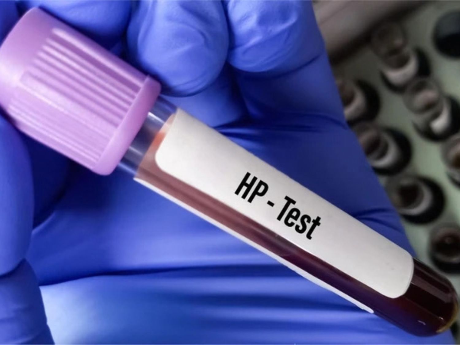 Xét nghiệm vi khuẩn Helicobacter pylori (HP) kịp thời giúp chủ động phòng ngừa các biến chứng viêm loét và nguy cơ tiến triển ác tính dạ dày.