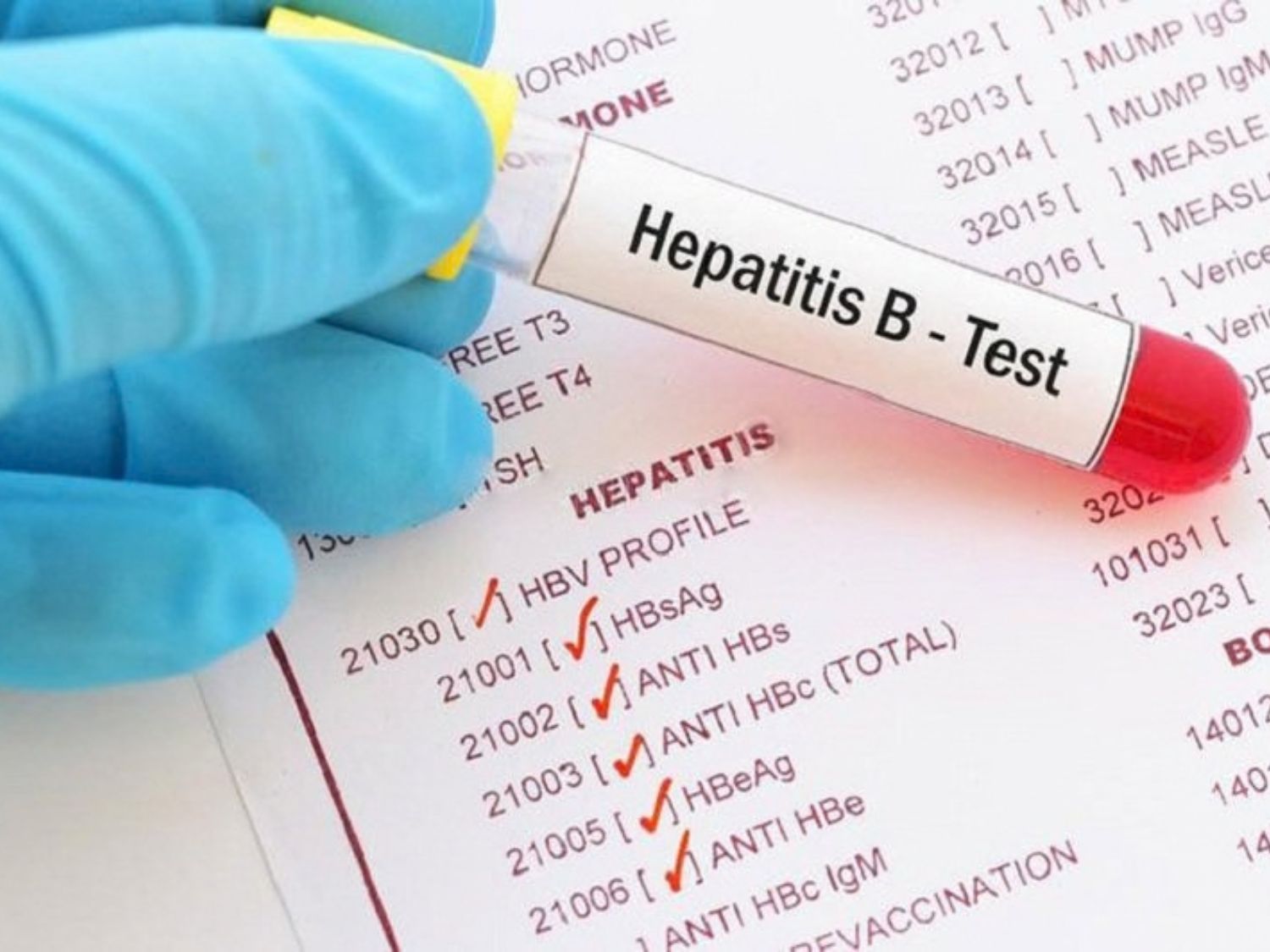 Nên để sau khoảng 4 tuần khi diệt vi khuẩn HP mới nên test lại