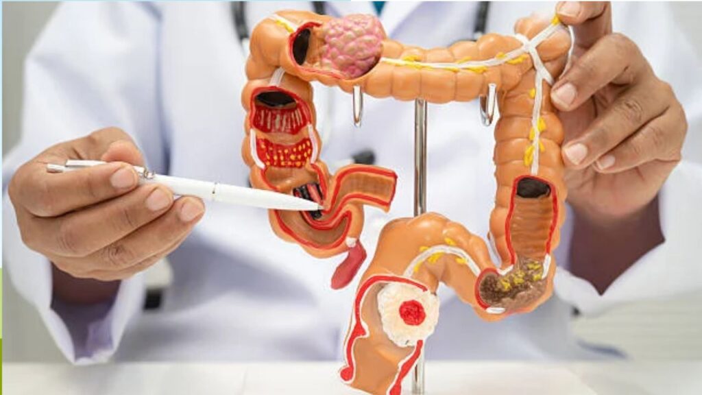Ai có nguy cơ cao bị ung thư đại trực tràng, khi nào tầm soát?