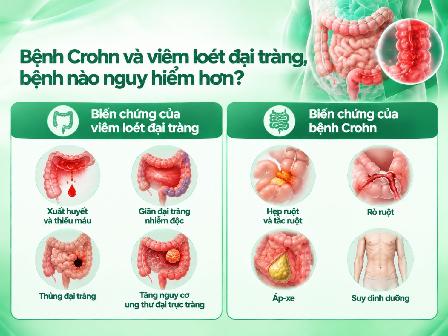 Cả viêm loét đại tràng và bệnh Crohn đều có nguy cơ gây biến chứng nghiêm trọng. Viêm loét đại tràng có thể dẫn đến xuất huyết, giãn đại tràng nhiễm độc hoặc thủng đại tràng; trong khi bệnh Crohn có thể gây hẹp ruột, tắc ruột, rò ruột và áp-xe. Mức độ nguy hiểm phụ thuộc vào tình trạng bệnh và khả năng kiểm soát viêm.