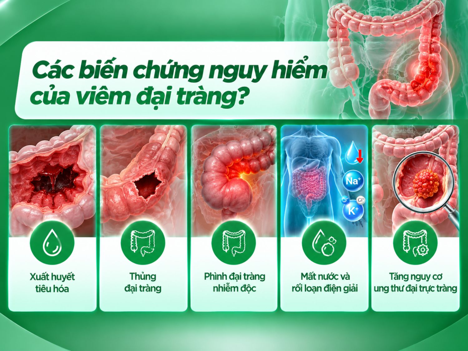 Viêm đại tràng có thể gây ra các biến chứng nghiêm trọng như xuất huyết tiêu hóa, thủng đại tràng, phình đại tràng nhiễm độc và mất nước. Một số bệnh viêm đại tràng mạn tính, đặc biệt là viêm loét đại tràng kéo dài, còn làm tăng nguy cơ ung thư đại trực tràng.
