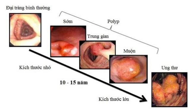 Một số polyp đại tràng, đặc biệt là polyp tuyến, có thể tiến triển thành ung thư qua nhiều năm. Quá trình này phụ thuộc vào đặc điểm mô bệnh học, kích thước và các yếu tố nguy cơ của người bệnh.