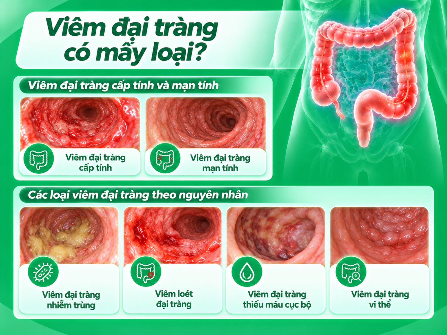 Viêm đại tràng là gì? Có mấy loại và cách phân biệt