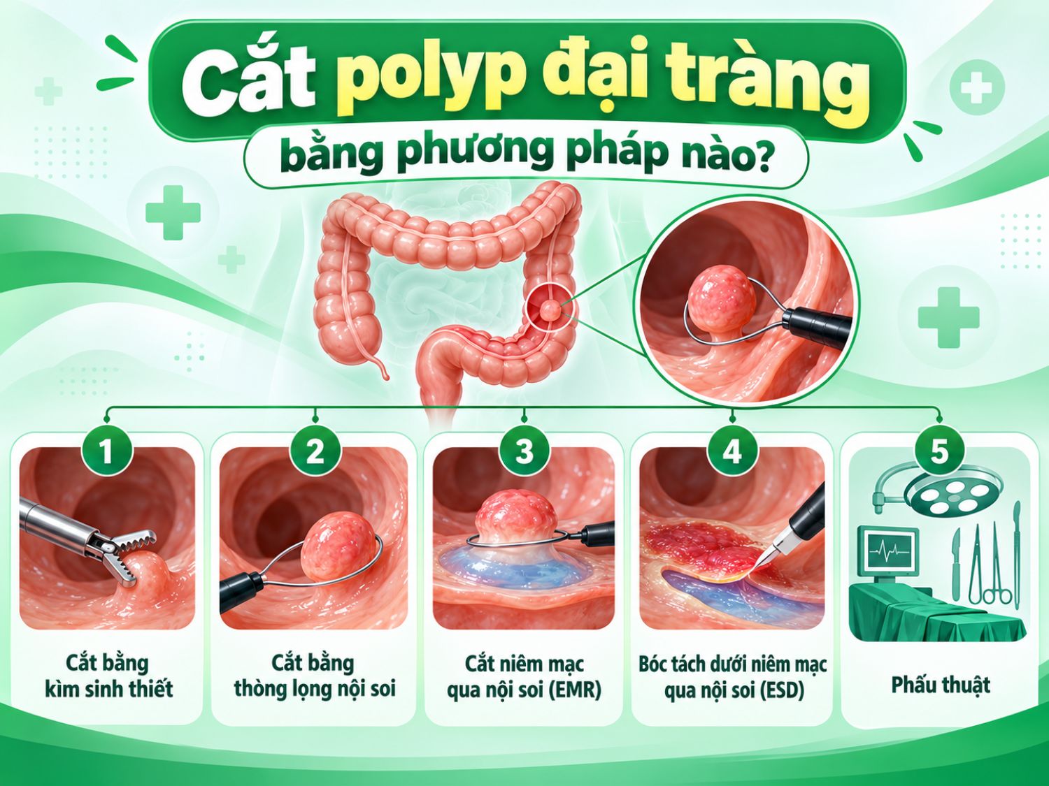 Polyp đại tràng có thể được loại bỏ bằng nhiều kỹ thuật như cắt qua nội soi bằng thòng lọng, EMR, ESD hoặc phẫu thuật. Phương pháp thực hiện phụ thuộc vào kích thước, vị trí, đặc điểm tổn thương và đánh giá của bác sĩ.