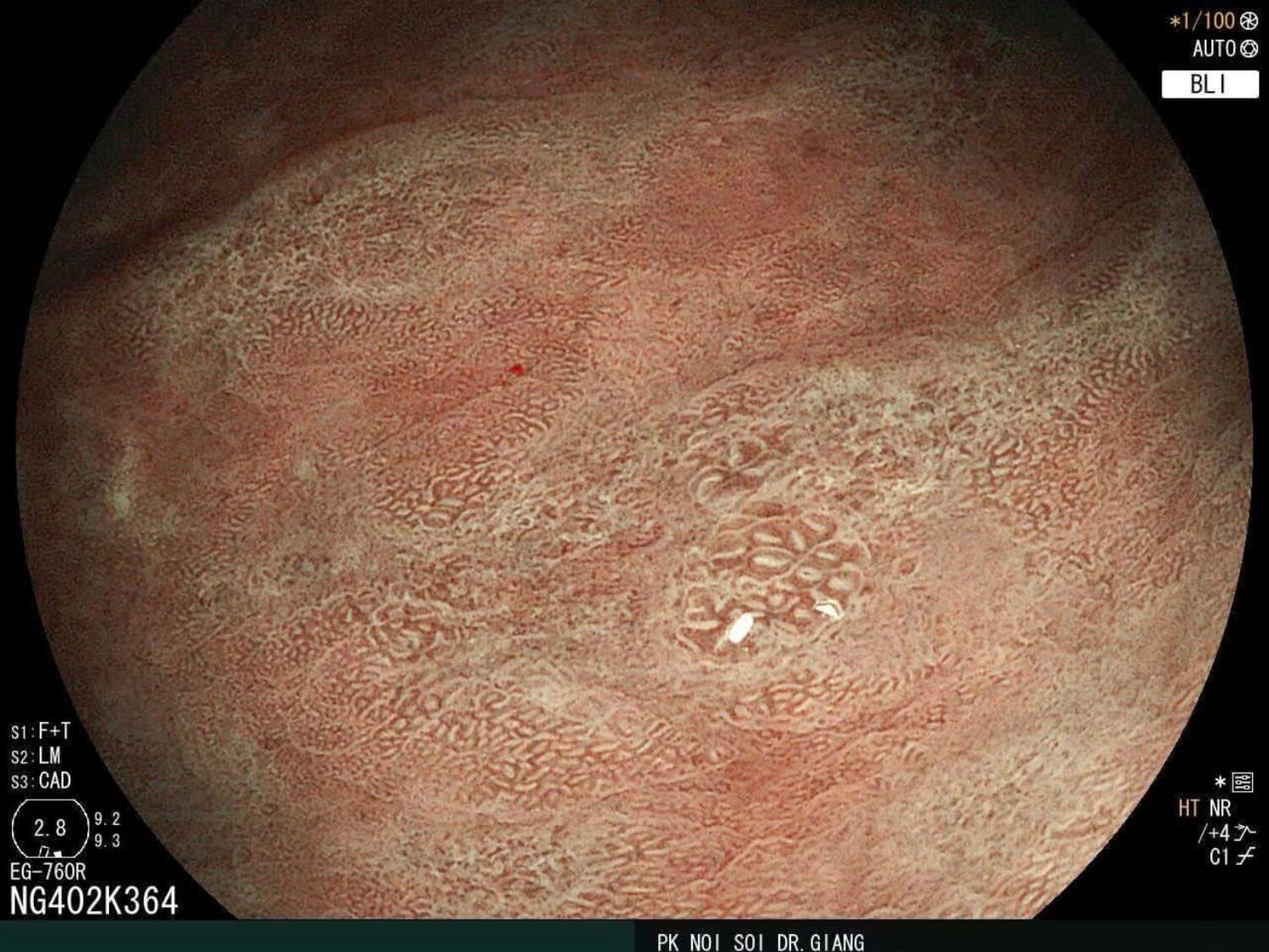 Công nghệ BLI (Blue Light Imaging) giúp tăng độ tương phản của cấu trúc bề mặt và mạch máu niêm mạc, hỗ trợ bác sĩ đánh giá những thay đổi trong quá trình nội soi tiêu hóa.