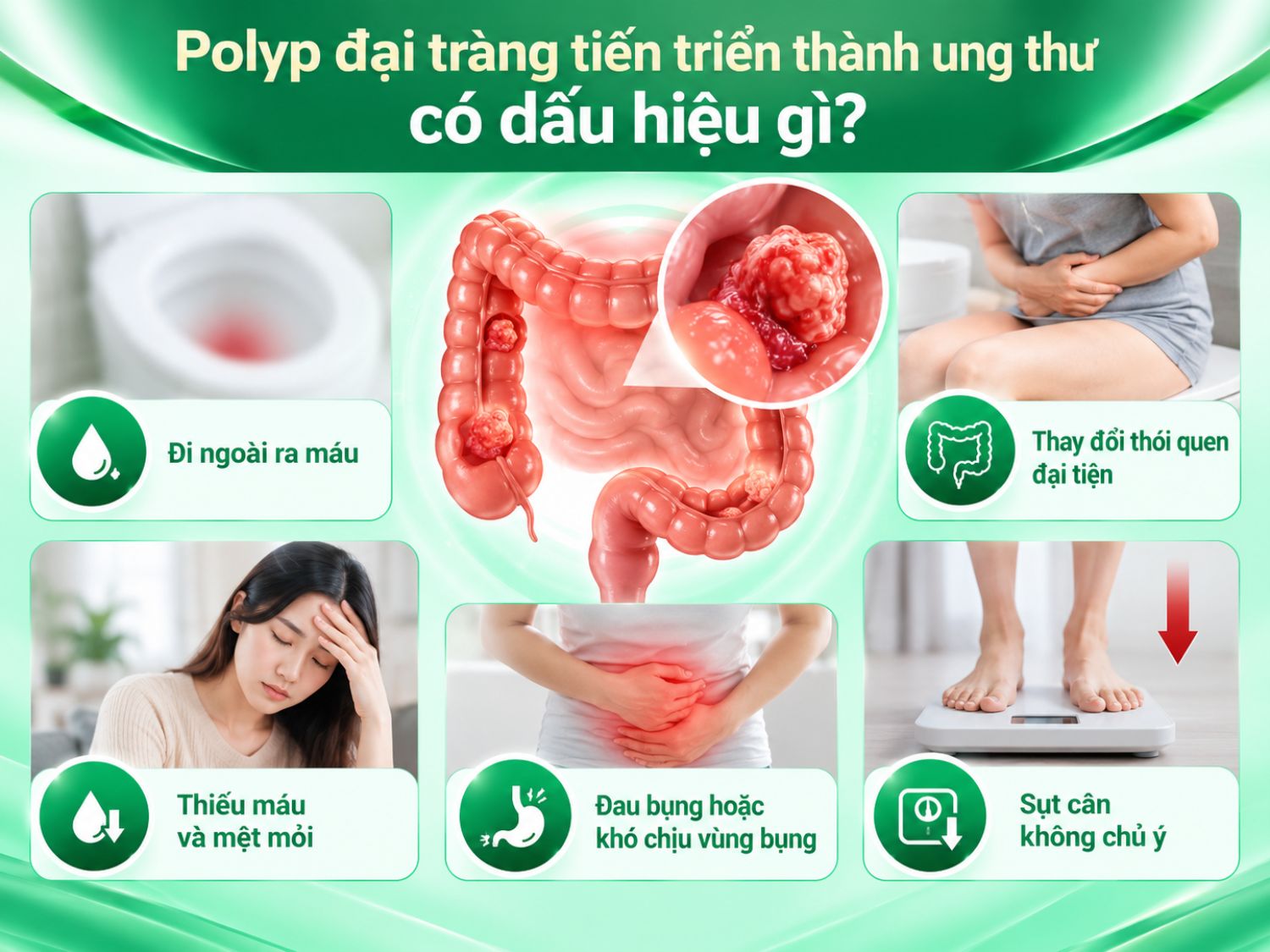 Polyp đại tràng có thể không gây triệu chứng ngay cả khi xuất hiện biến đổi tiền ung thư. Người bệnh cần chủ động tầm soát, không nên chờ đến khi có dấu hiệu bất thường mới đi nội soi.