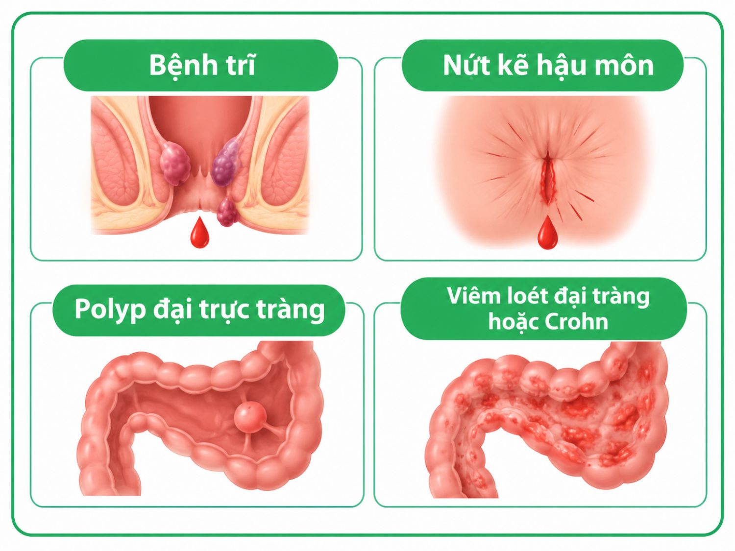 ảnh mô tả Các nguyên nhân không phải ung thư gây đi ngoài ra máu