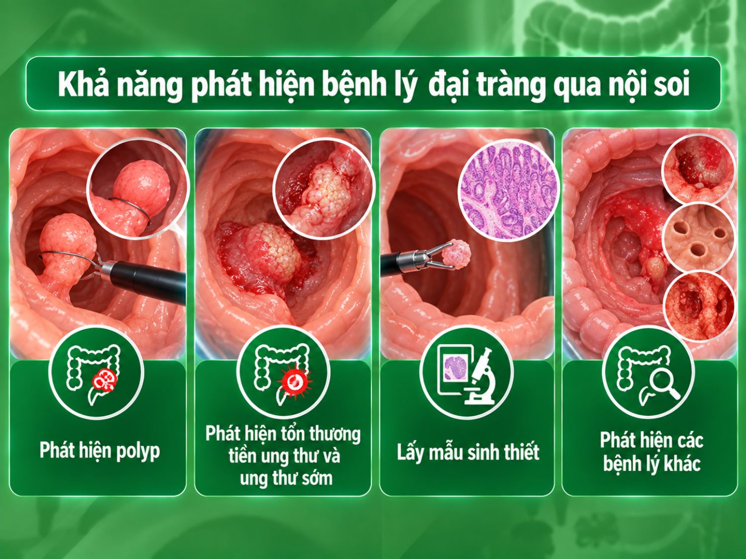 Nội soi đại tràng giúp quan sát trực tiếp niêm mạc, hỗ trợ phát hiện polyp, tổn thương tiền ung thư, ung thư sớm, đồng thời có thể lấy mẫu sinh thiết khi cần.