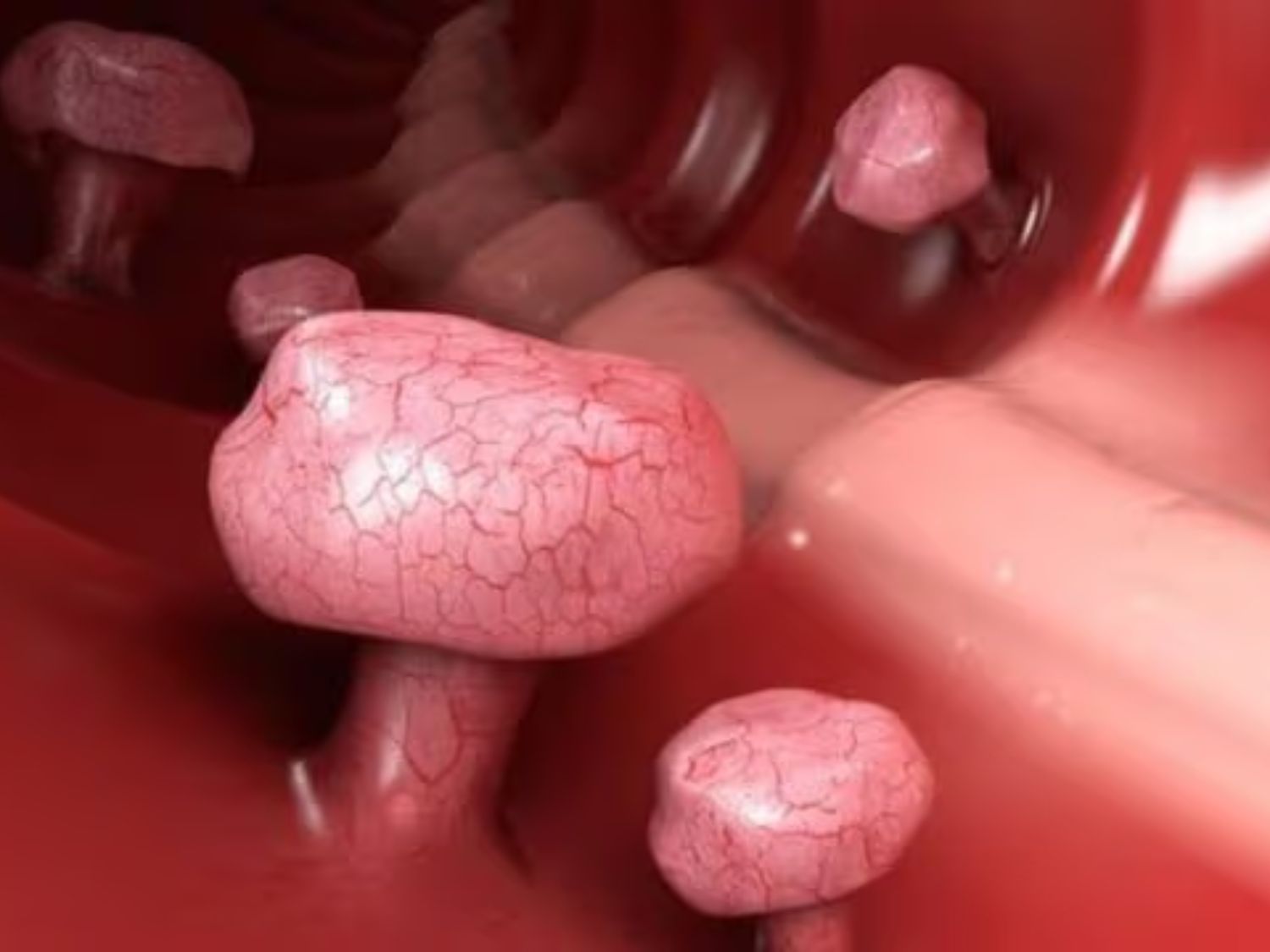 Người có nhiều polyp đại tràng cần được đánh giá số lượng, kích thước và đặc điểm mô bệnh học để xác định nguy cơ ung thư và xây dựng kế hoạch điều trị, theo dõi phù hợp.
