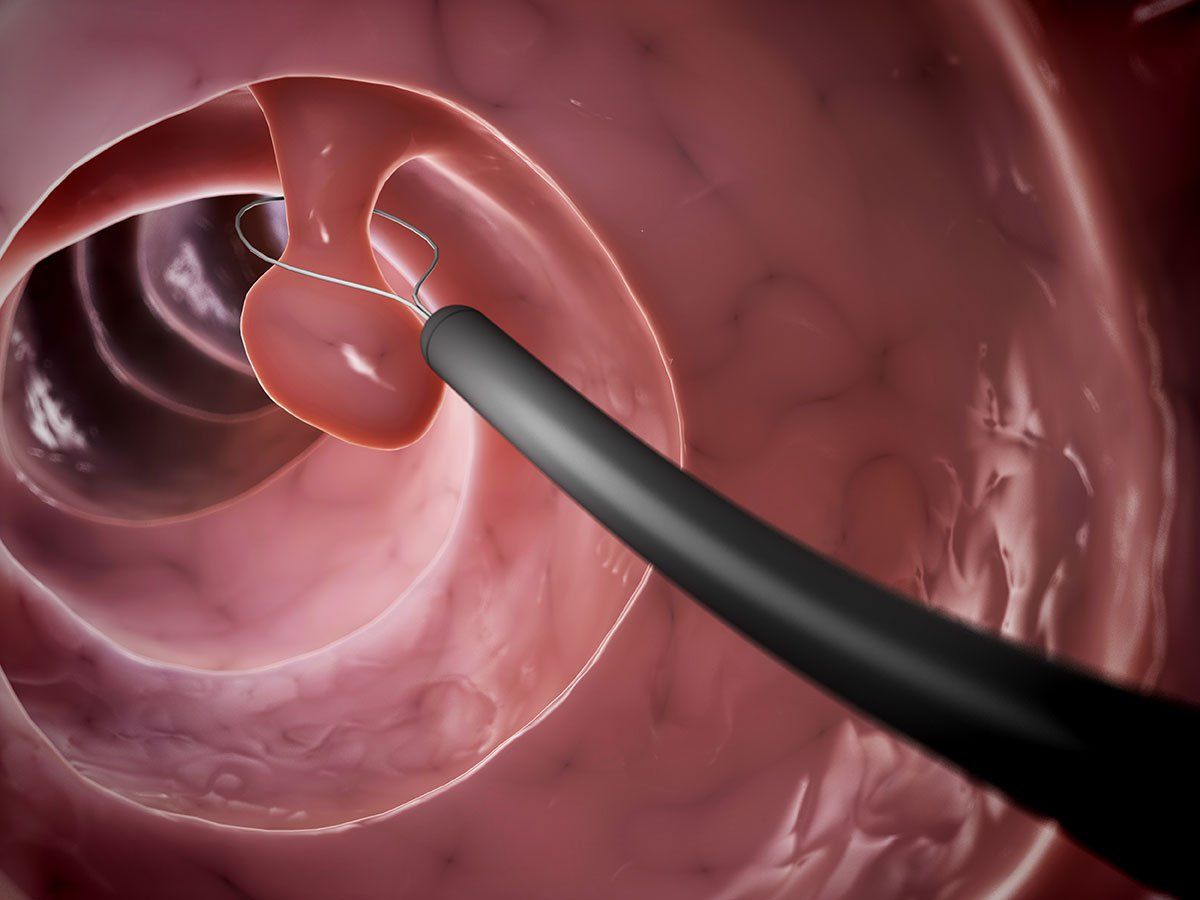 Trường hợp có polyp bác sĩ sẽ thực hiện cắt luôn