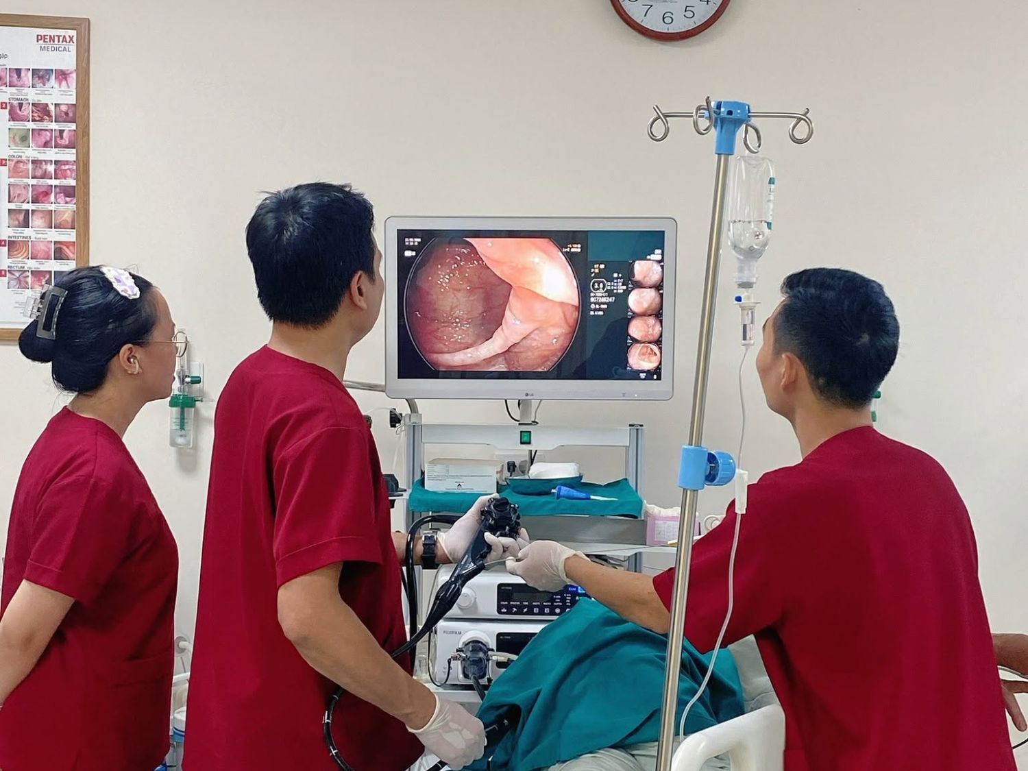 Các tổn thương dạng nốt hoặc khối nhô lên trên niêm mạc đại tràng có thể liên quan đến nhiều bệnh lý khác nhau. Nội soi kết hợp sinh thiết khi cần thiết giúp bác sĩ phân biệt tổn thương viêm, polyp và các bất thường khác.Nội soi đại tràng là phương pháp giúp bác sĩ quan sát trực tiếp niêm mạc, phát hiện các dấu hiệu viêm, loét, polyp hoặc tổn thương bất thường. Tại Phòng khám Đa khoa Tiêu Hóa Việt, bác sĩ thực hiện nội soi và đánh giá kết quả để đưa ra hướng theo dõi, điều trị phù hợp.