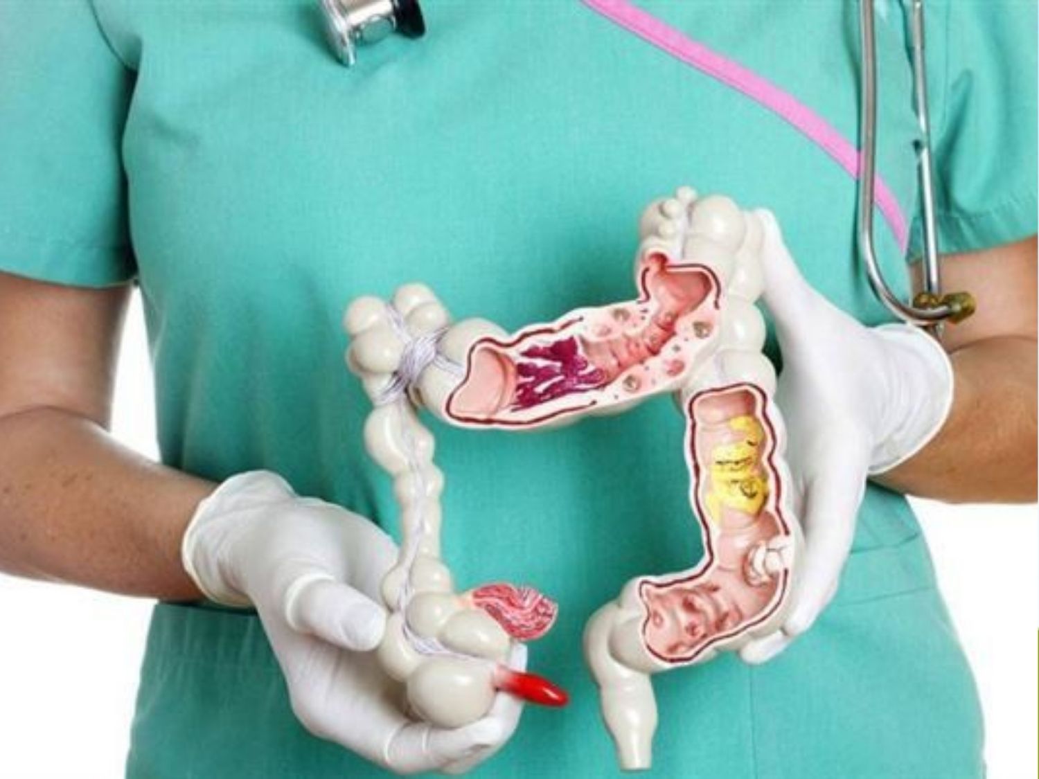 Nội soi đại tràng ảo (CT Colonography) là kỹ thuật chẩn đoán hình ảnh sử dụng máy chụp cắt lớp vi tính (CT) để tái tạo hình ảnh hai chiều