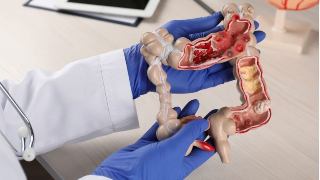 Nội soi đại tràng ảo (CT colonography) khác nội soi thường thế nào?