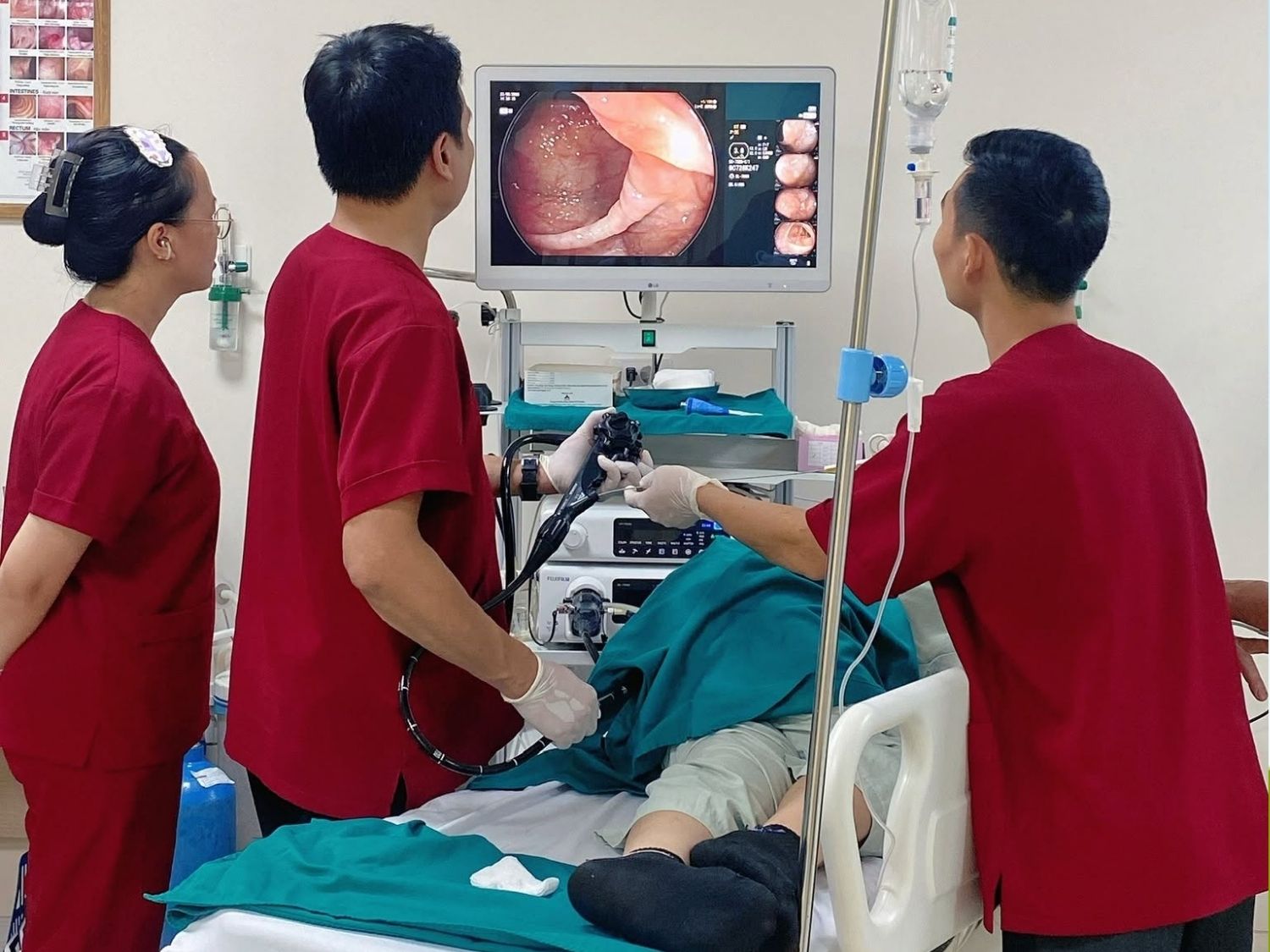 Nội soi đại tràng bằng ống mềm là phương pháp đưa một ống nội soi mềm có gắn camera và nguồn sáng qua hậu môn