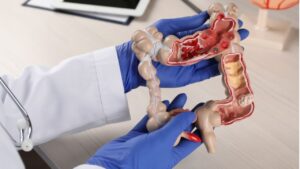 Nội soi đại tràng ảo (CT colonography) khác nội soi thường thế nào?