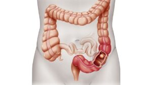 Nội soi đại tràng có phát hiện ung thư và polyp không?