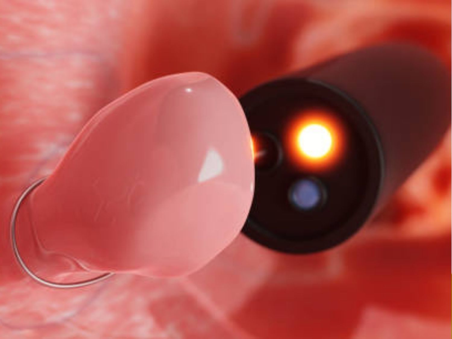 Nội soi đại tràng bằng AI có phát hiện polyp