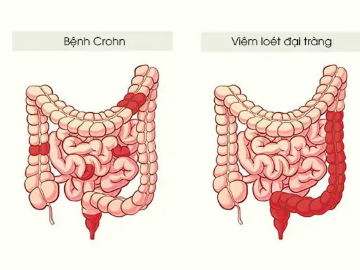 Bệnh Crohn có thể ảnh hưởng đến nhiều đoạn của đường tiêu hóa, với các vùng viêm xen kẽ mô lành. Trong khi đó, viêm loét đại tràng chủ yếu gây viêm liên tục ở niêm mạc đại tràng, thường bắt đầu từ trực tràng. Việc phân biệt hai bệnh giúp bác sĩ lựa chọn phương pháp điều trị phù hợp.