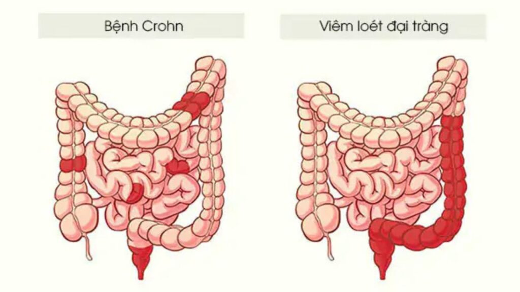 Viêm loét đại tràng và bệnh Crohn khác nhau thế nào? Cách phân biệt hai bệnh