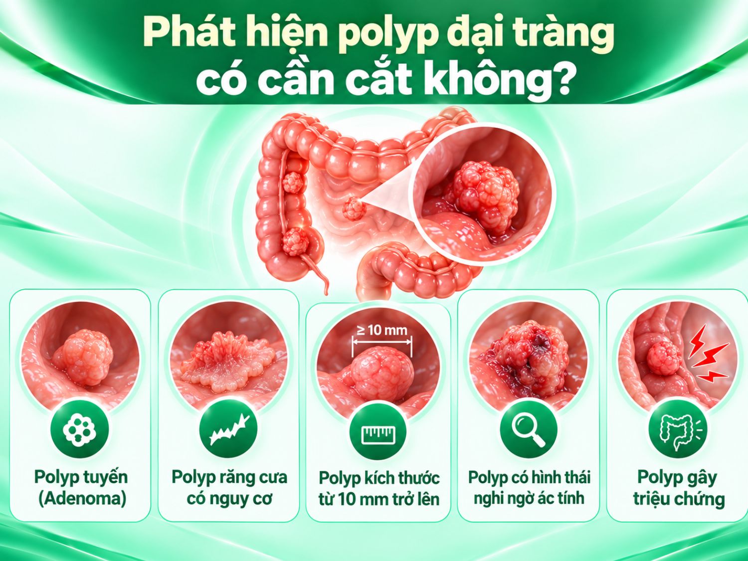 Bác sĩ cân nhắc cắt polyp đại tràng dựa trên kích thước, hình thái, đặc điểm mô bệnh học và triệu chứng. Những polyp nghi ngờ ác tính cần được đánh giá kỹ để lựa chọn phương pháp xử lý phù hợp.