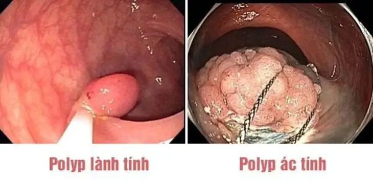 Polyp đại tràng có thể có hình dạng và kích thước khác nhau. Hình ảnh nội soi giúp bác sĩ đánh giá đặc điểm tổn thương, nhưng cần kết quả mô bệnh học để xác định polyp lành tính hay ác tính.