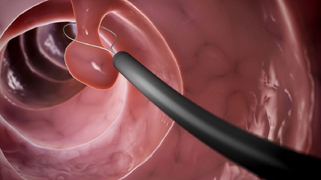 Polyp đại tràng có cần cắt không? Khi nào nên can thiệp?