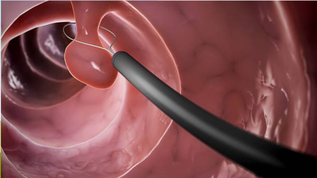 Polyp đại tràng có phải là ung thư không, bao lâu thành ung thư?