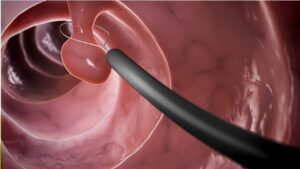 Polyp đại tràng có phải là ung thư không, bao lâu thành ung thư?
