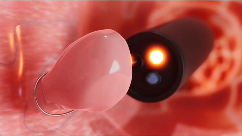 Polyp đại tràng tái phát: Vì sao polyp mọc lại sau khi cắt?