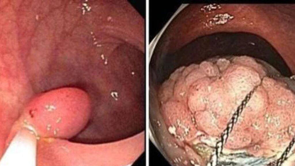 Polyp đại tràng bao lâu thì thành ung thư? Yếu tố quyết định nguy cơ