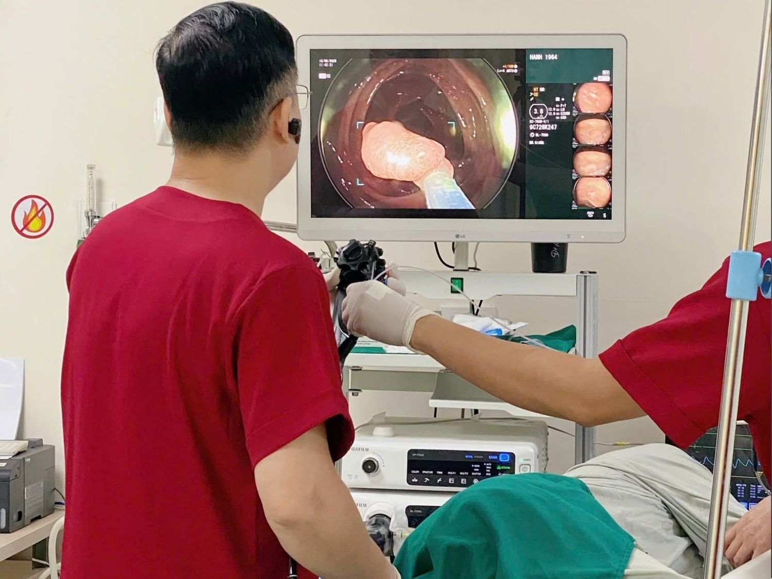 Tầm soát ung thư đại trực tràng giúp phát hiện và loại bỏ các polyp