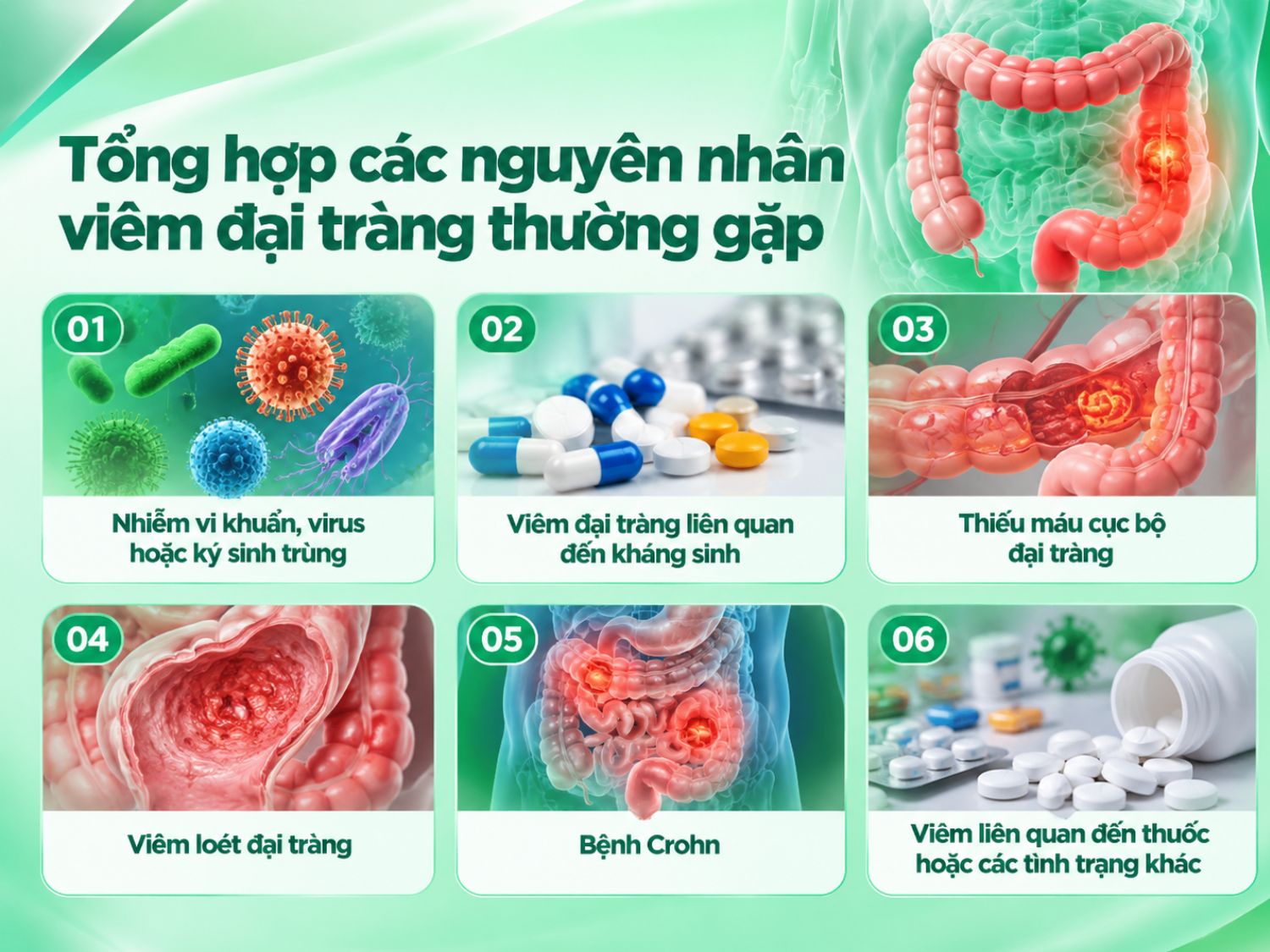 Viêm đại tràng có thể xuất phát từ nhiều nguyên nhân như nhiễm trùng đường ruột, tác dụng của thuốc, thiếu máu cục bộ hoặc các bệnh viêm ruột mạn tính như viêm loét đại tràng và Crohn. Xác định đúng nguyên nhân giúp bác sĩ lựa chọn phương pháp điều trị phù hợp.