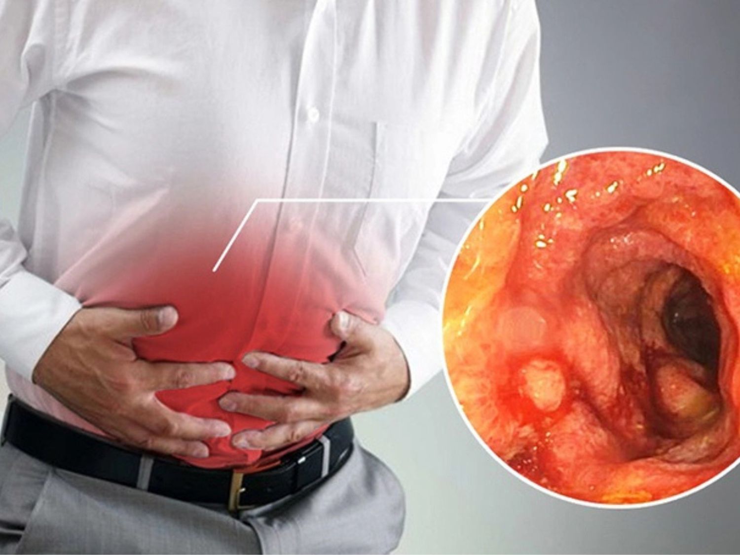 Đôi khi triệu chứng viêm đại tràng dễ bị nhầm lẫn với những bệnh lý khác
