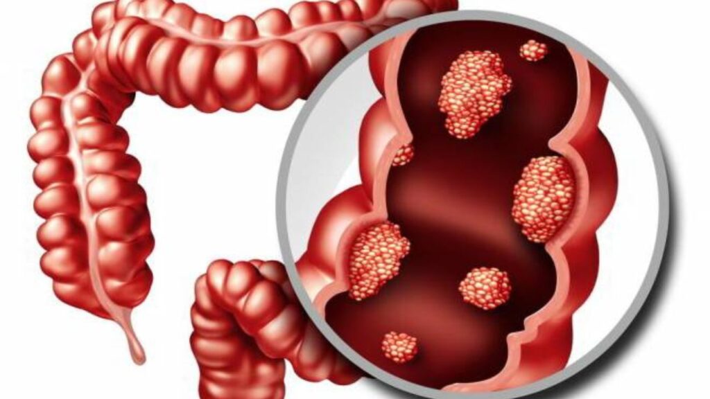 Triệu chứng viêm đại tràng gồm những gì? Dấu hiệu cần nhận biết