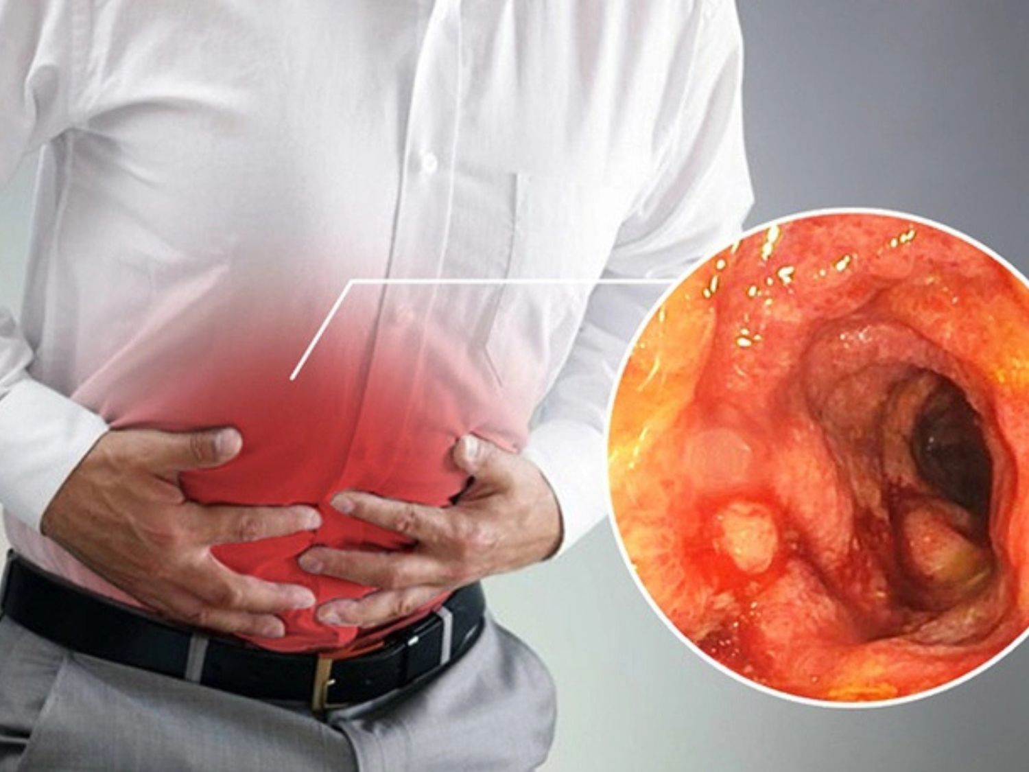 Viêm đại tràng có thể gây đau bụng, tiêu chảy, thay đổi thói quen đại tiện, đi ngoài có máu hoặc chất nhầy. Khi các triệu chứng kéo dài, tái phát nhiều lần hoặc xuất hiện dấu hiệu bất thường, người bệnh nên thăm khám chuyên khoa Tiêu hóa để xác định nguyên nhân và có hướng điều trị phù hợp.