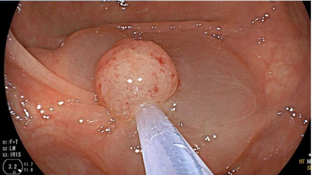 Tỷ lệ phát hiện polyp (ADR) của bác sĩ có quan trọng không?