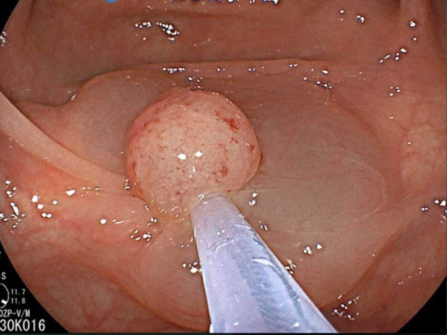 Tỷ lệ phát hiện polyp (ADR) là phần trăm số ca nội soi đại tràng mà bác sĩ phát hiện