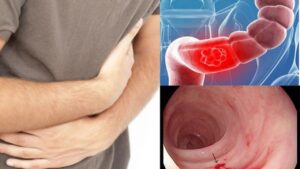 Viêm đại tràng có chữa khỏi không? Cách điều trị và phòng tái phát