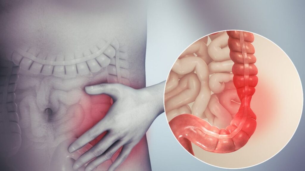 Viêm đại tràng co thắt là gì? Có phải hội chứng ruột kích thích IBS?