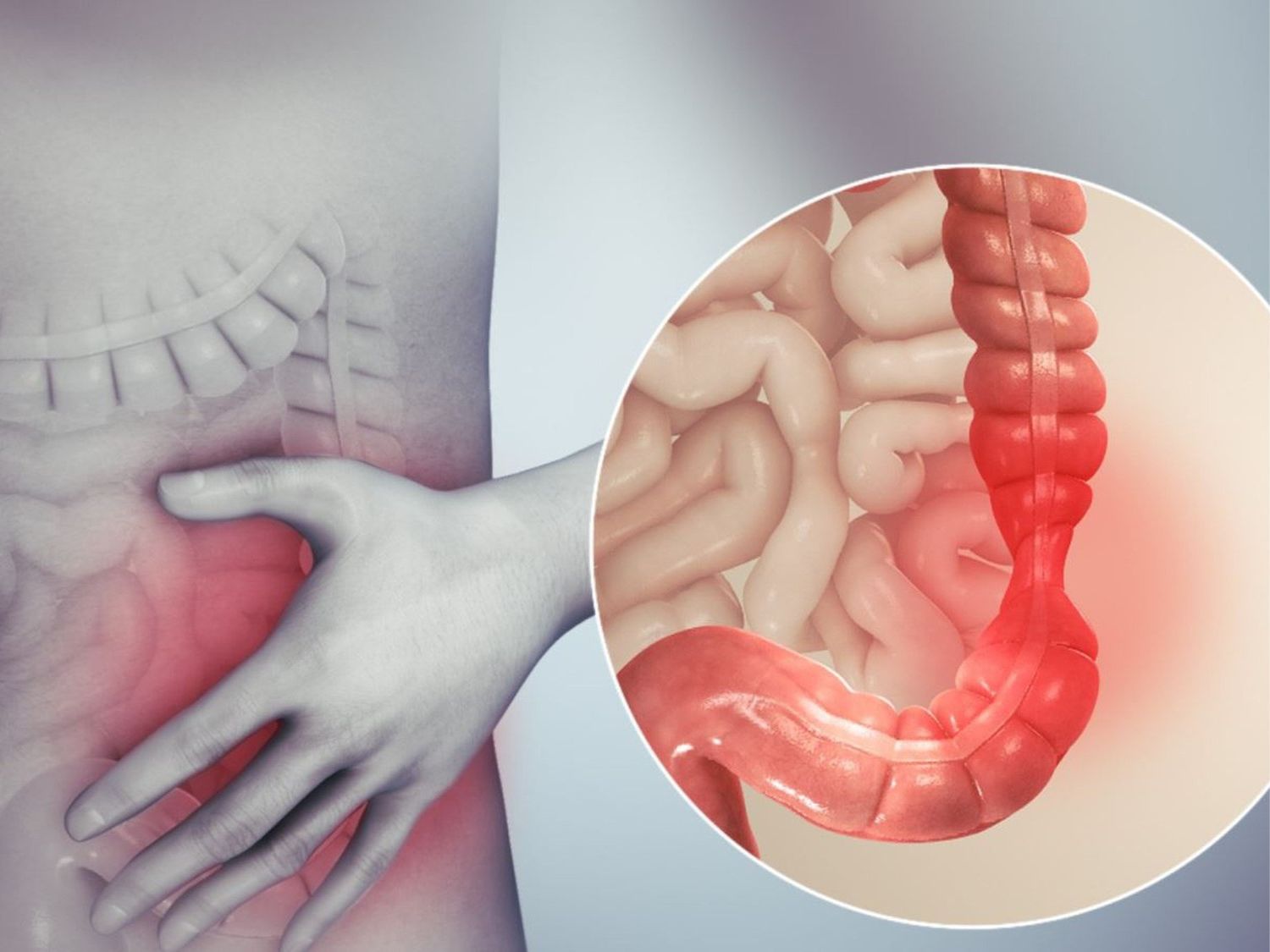 Viêm đại tràng co thắt khác so với bệnh viêm đại tràng