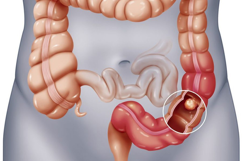 Nội soi gây mê phù hợp với những trường hợp muốn quá trình nội soi diễn ra thoải mái